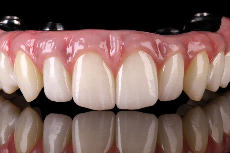 Имплантация всех зубов как метод восстановления всех зубов беззубым пациентам