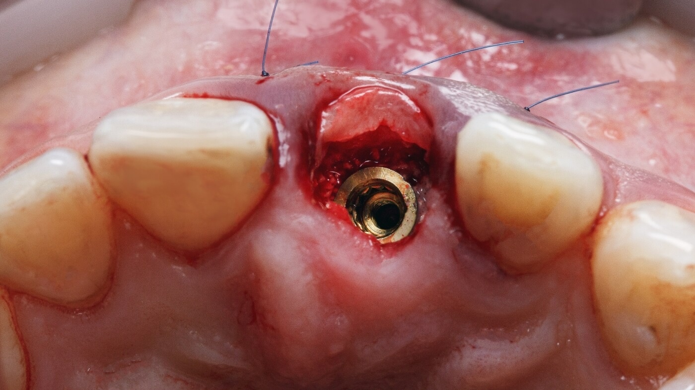 Лунка удаленного зуба с установленным имплантатом