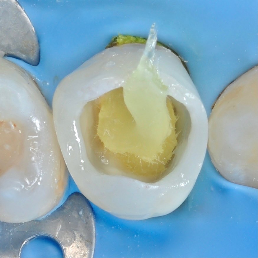 восстановление коронковой части зуба в процессе лечения под микроскопом
