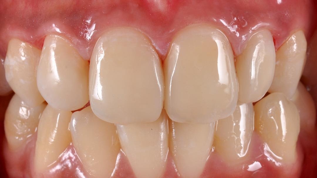 передние зубы после лечения кариеса между ними