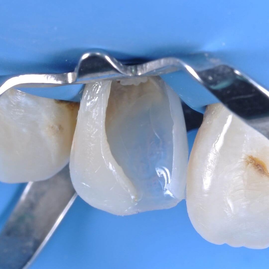 восстановление формы зуба в процессе лечения кариеса