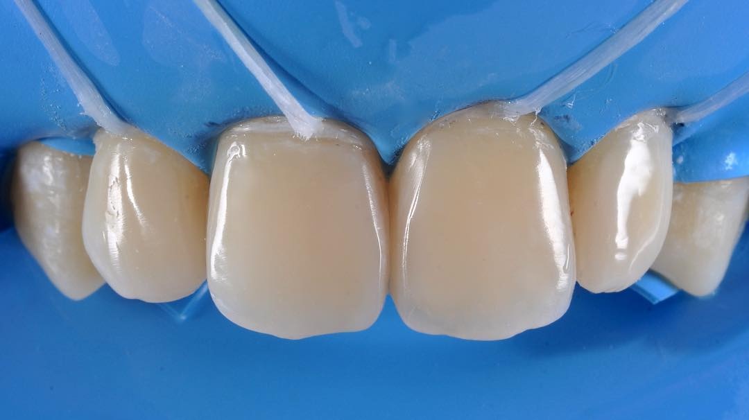 Передние зубы после лечения кариеса и эстетической реставрации в Ставрополе