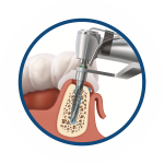 Установка имплантата входит в стоимость имплантации зубов под ключ