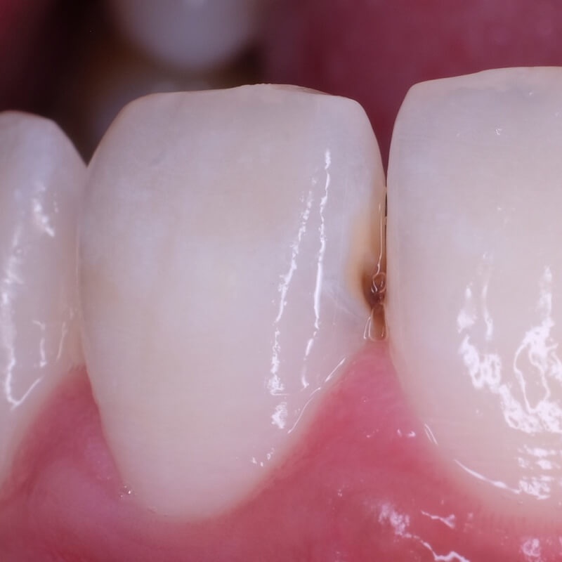 фото передних зубов до лечения кариеса