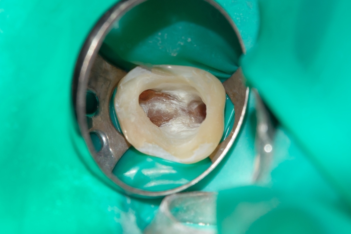 фото зуба в процессе лечения пульпита