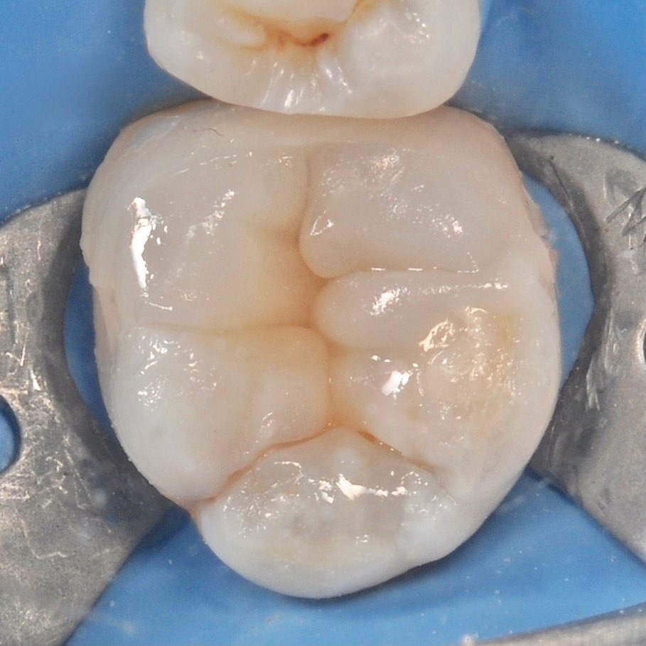 жевательный зуб с восстановленной формой после лечения под микроскопом