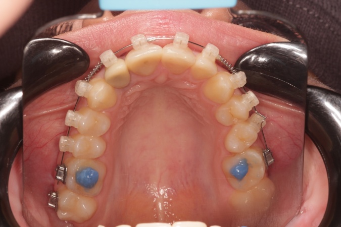 Фото зубов верхней челюсти пациента с установленными брекетами для исправления прикуса