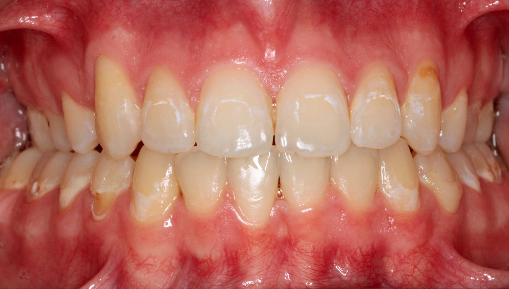 фото зубов пациента после ортодонтического лечения по коррекции положения зубов