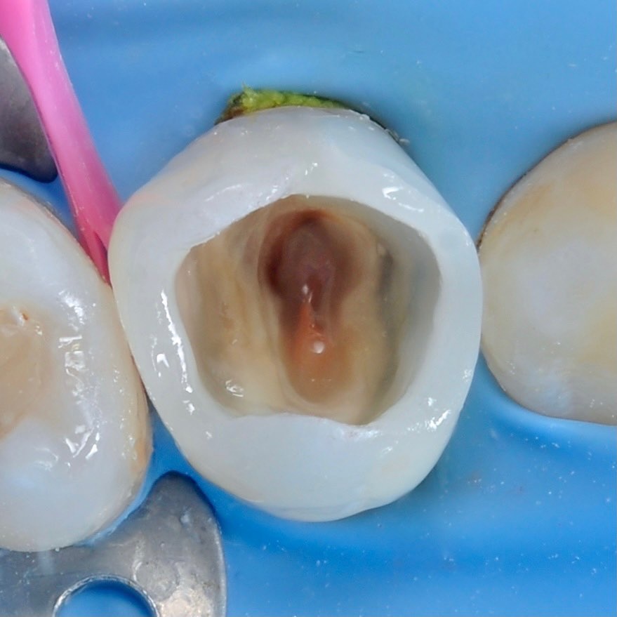 восстановление формы зуба в процессе лечения под микроскопом