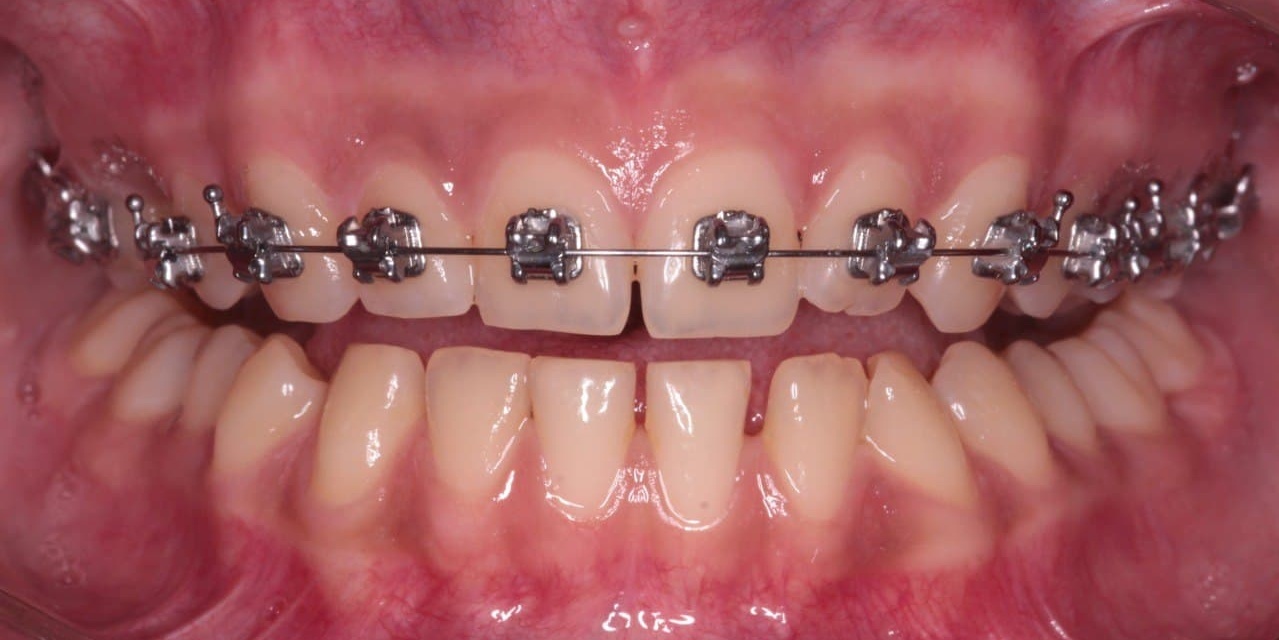 фото зубов пациента в процессе ортодонтического лечения по исправлению прикуса