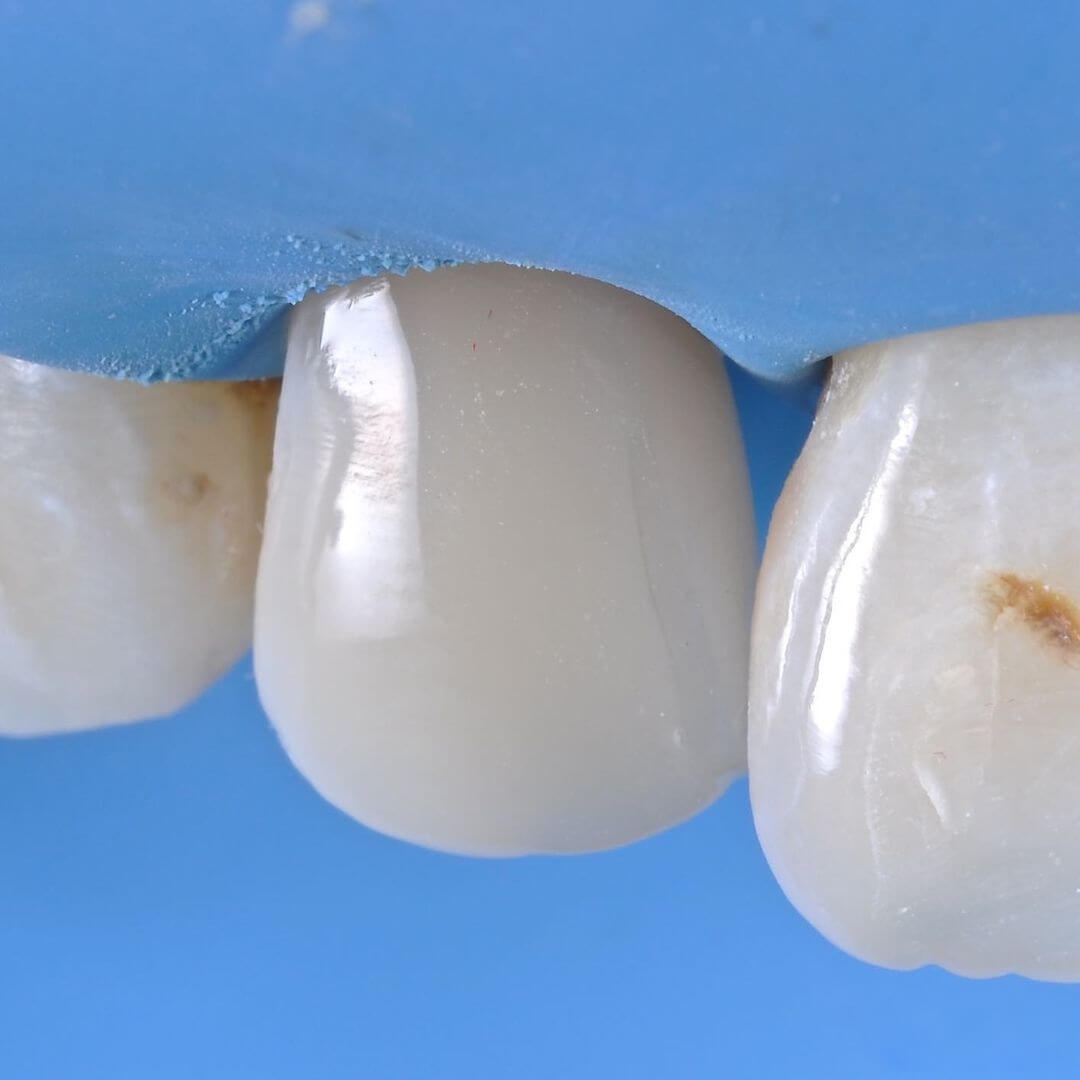 зуб после лечения и восстановления в стоматологии