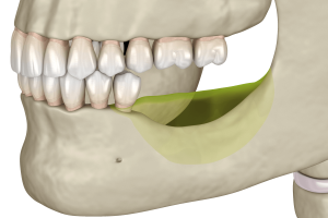 иллюстрация демонстрирующая операцию по костной пластике на нижней челюсти