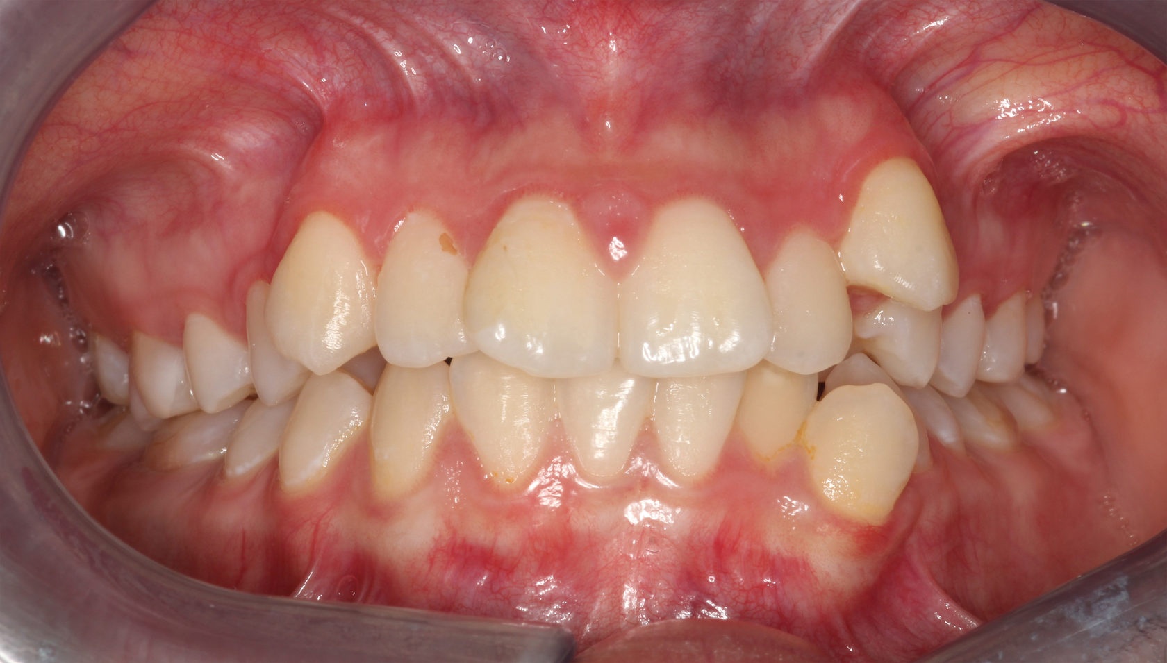 фото зубов пациента до ортодонтического лечения по коррекции прикуса