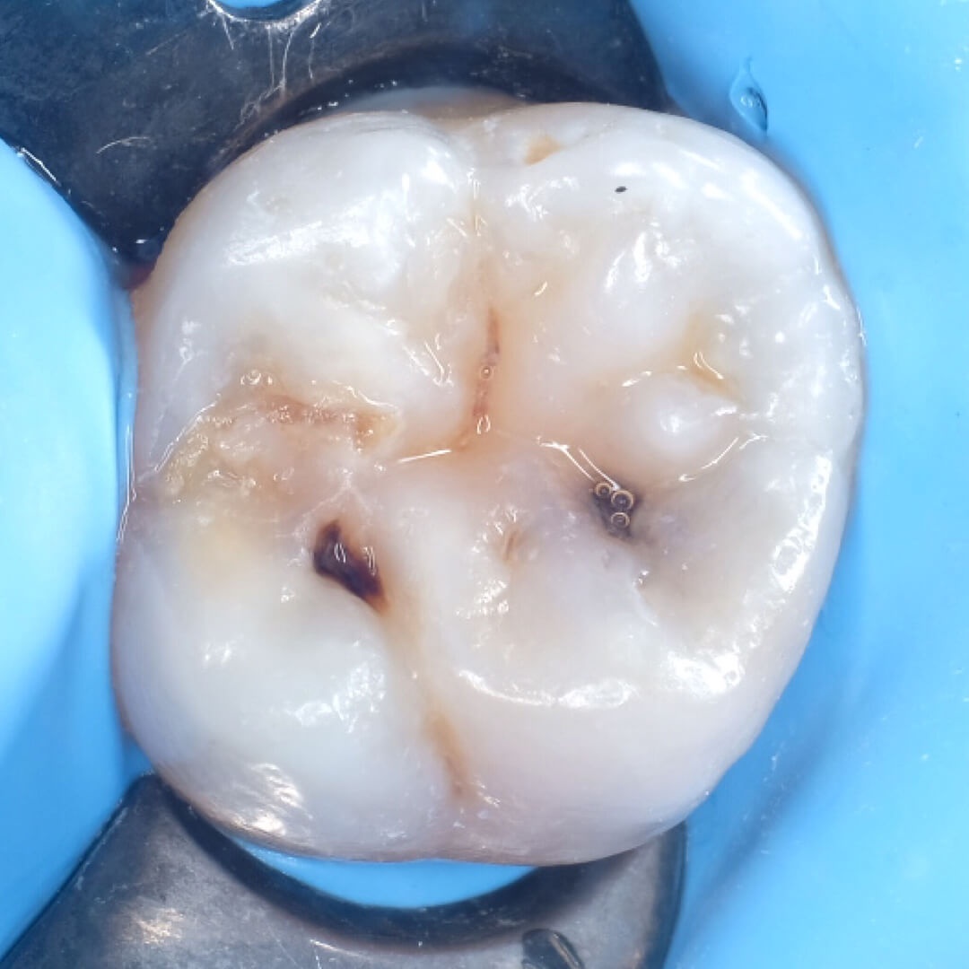фото жевательного зуба с кариесом который требуется лечить