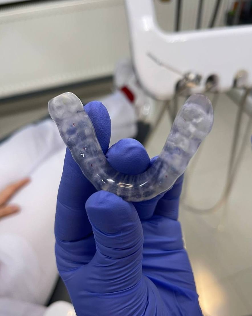 Ортодонтическая каппа, для исправления прикуса и положения ВНЧС