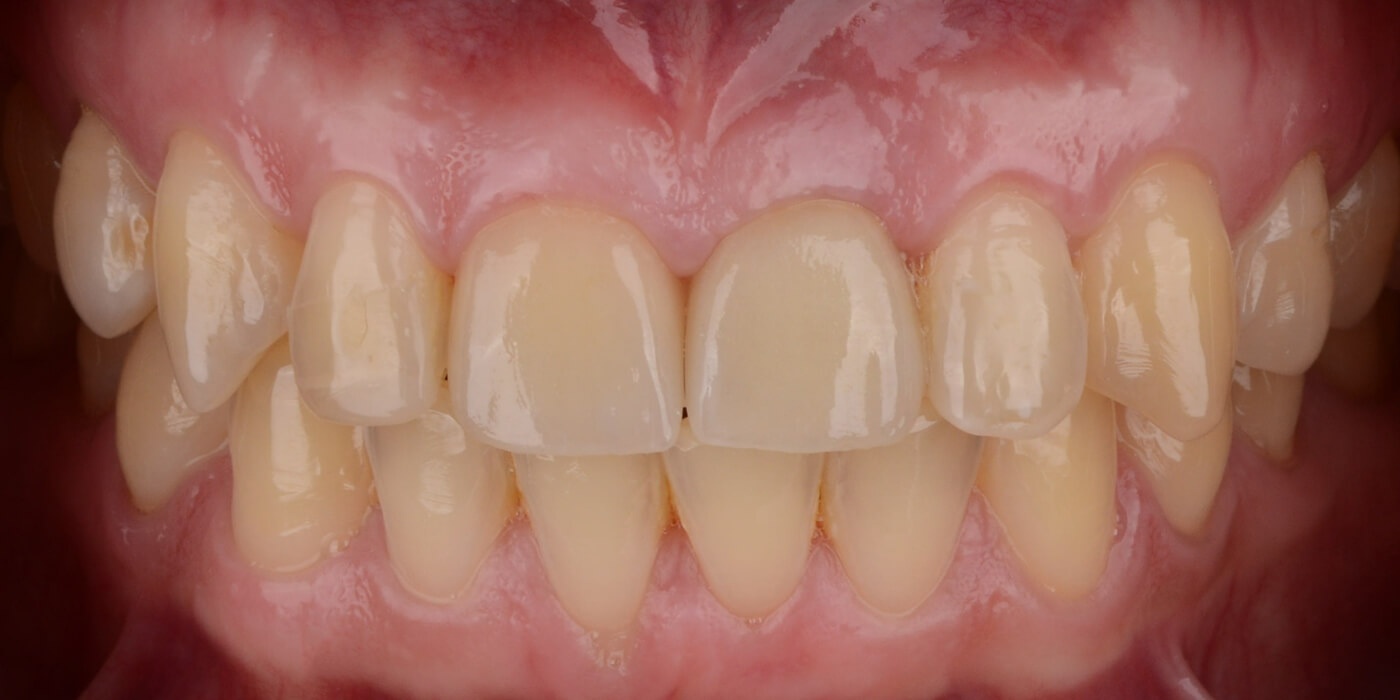 зафиксированная коронка на имплантате восстанавливает зубной ряд