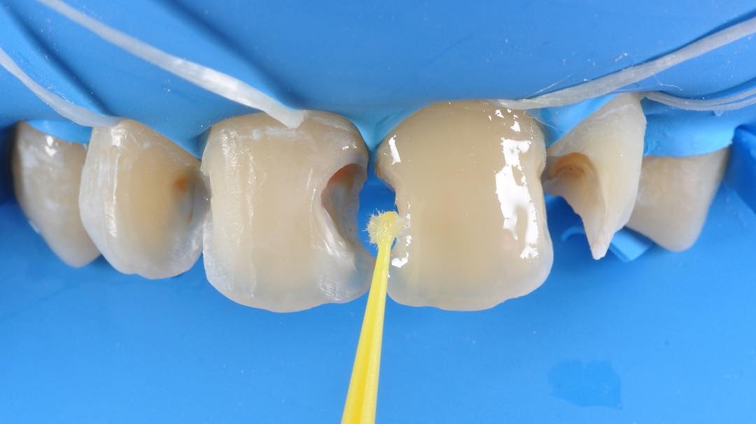 Передние зубы в процессе реставрации и лечении кариеса между ними