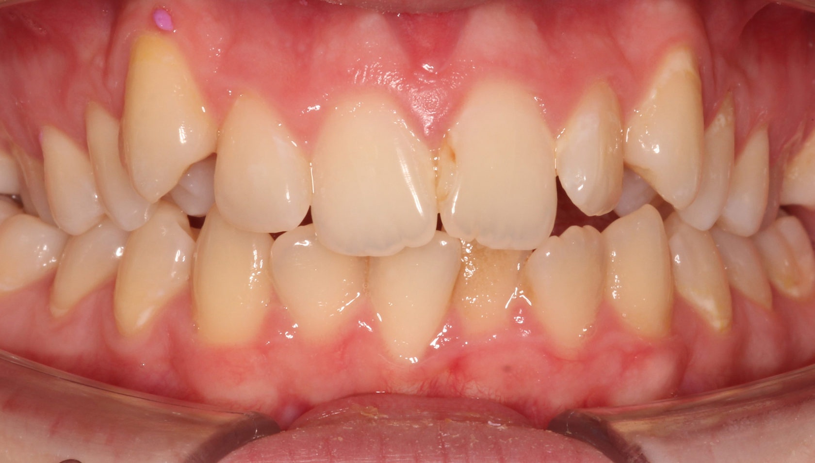 фото зубов пациента до ортодонтического лечения по коррекции положения зубов