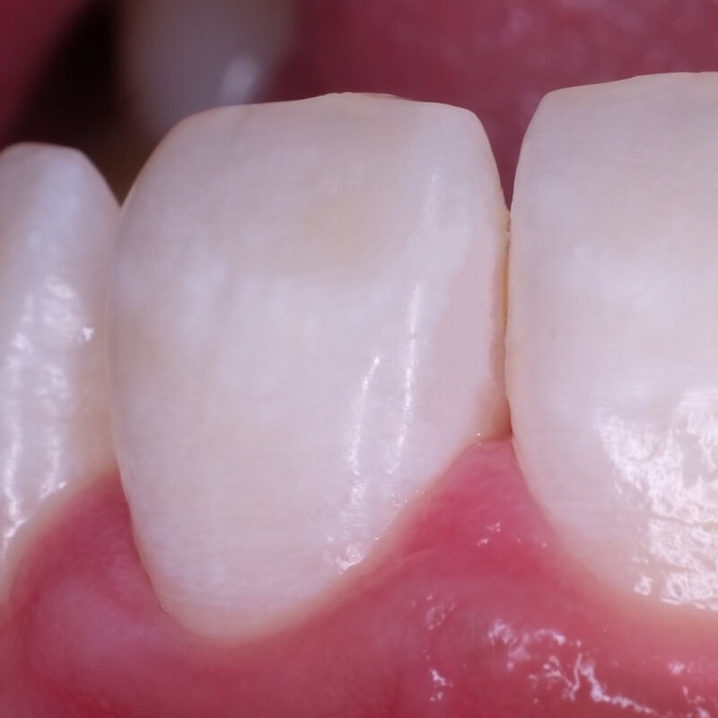 фото передних зубов после лечения кариеса