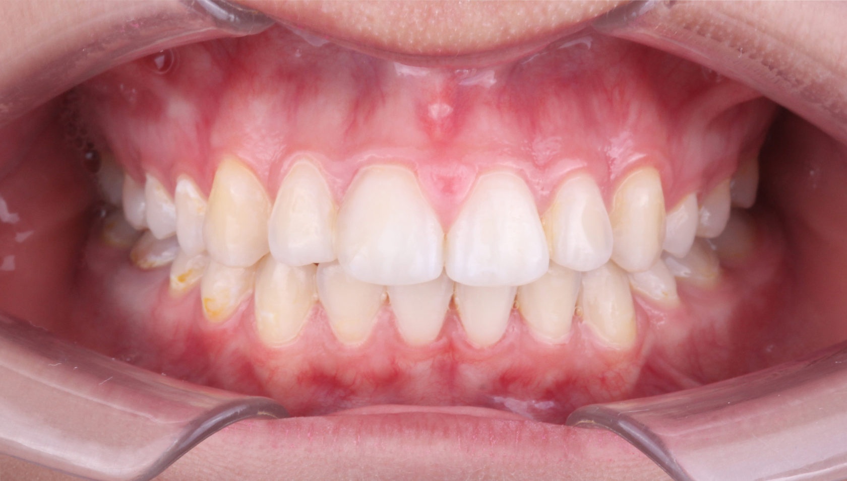 фото зубов пациента после ортодонтического лечения по коррекции прикуса