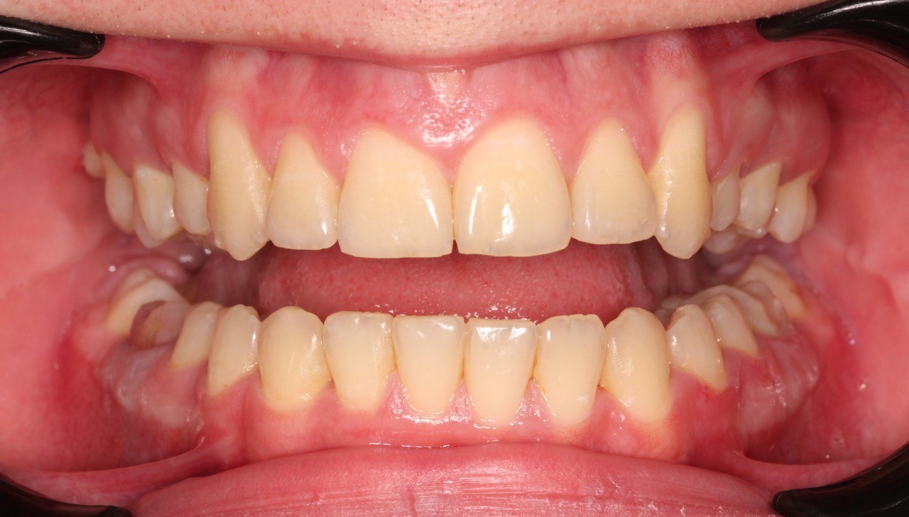 Пример до и после исправления прикуса ортодонтом стоматологии Стомион в Ставрополе