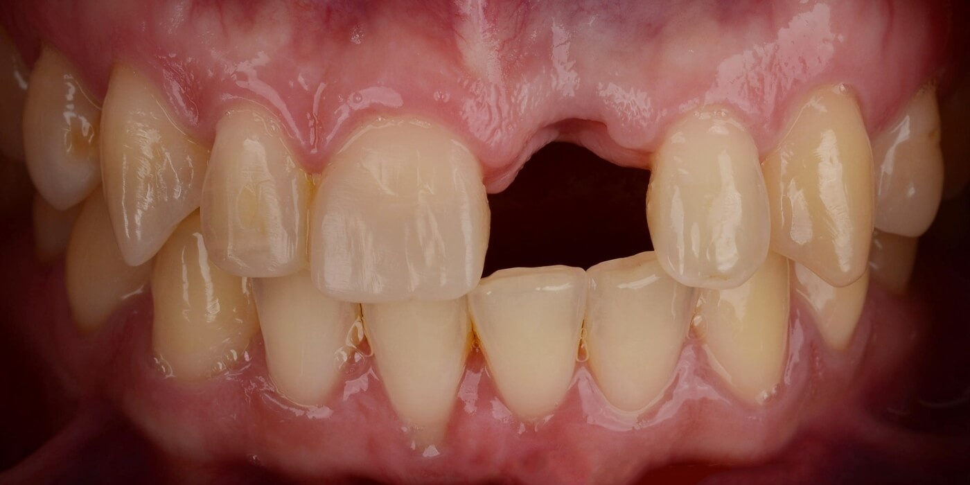 потерянный в результате травмы передний зуб требует импланатции