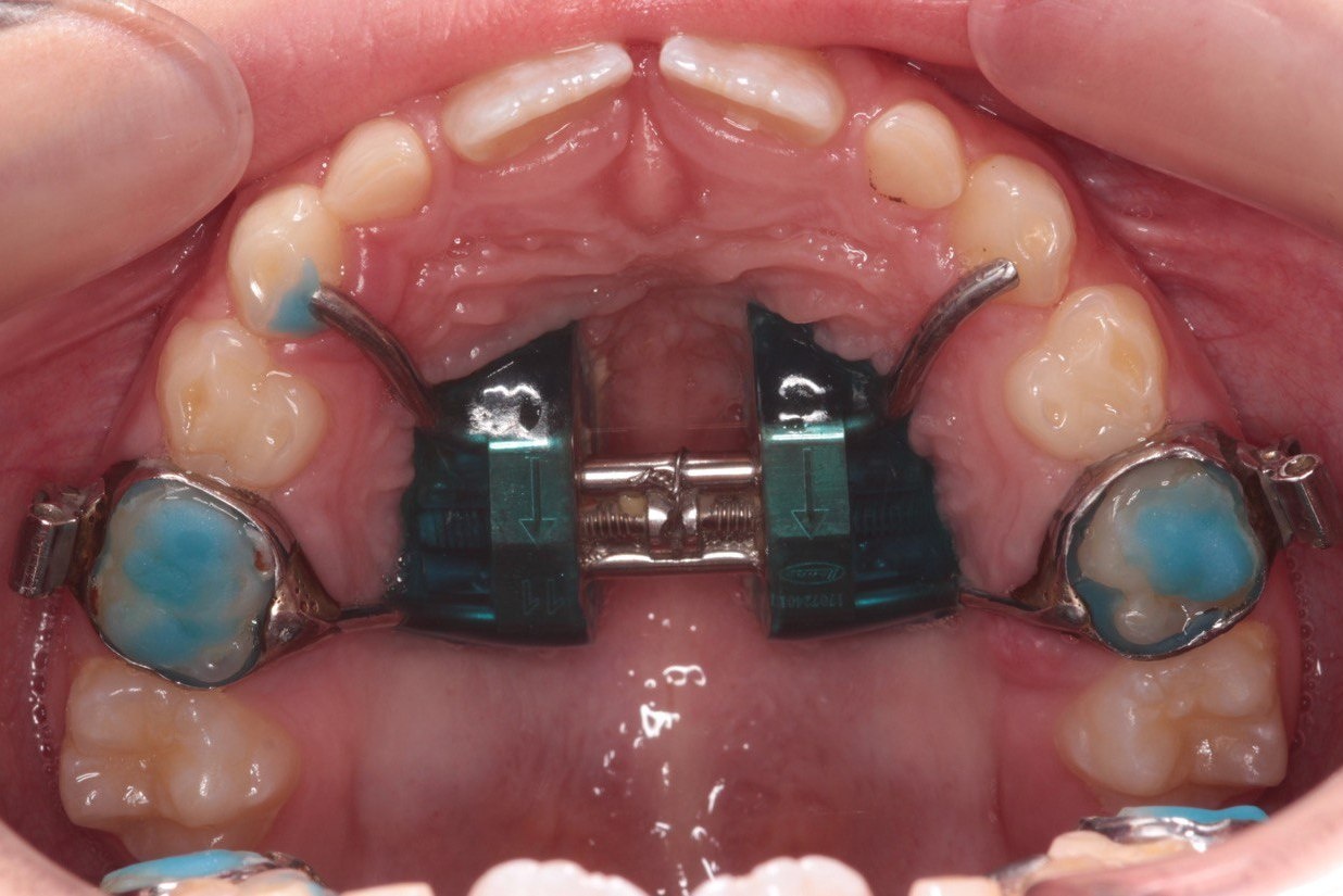 Фото ортодонтического аппарата расширяющего зубную дугу в полости рта