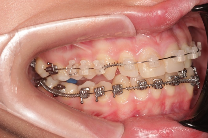 Боковое фото зубов пациента с установленными брекетами для исправления прикуса