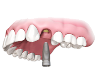Установка дентального имплантата в стоматологии Стомион