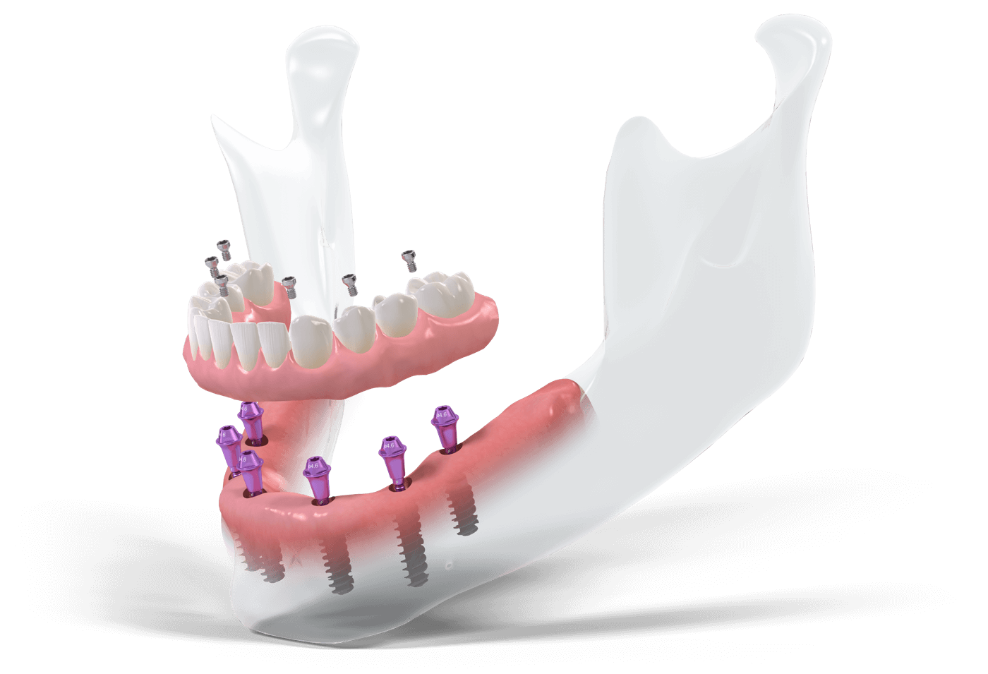 Модель челюсти с установленными имплантатами и протезом челюсти по протоколу имплантации всех зубов Все на 4 | All on 4