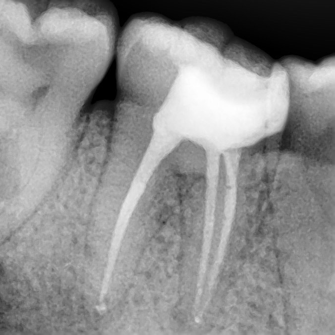 контрольный рентген зуба после лечения зуба под микроскопом