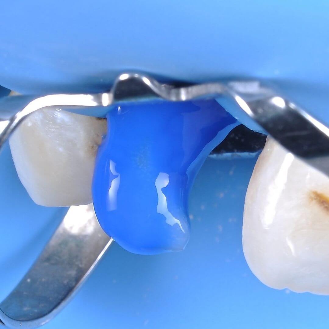 обломанный зуб обрабатывают в процессе лечения