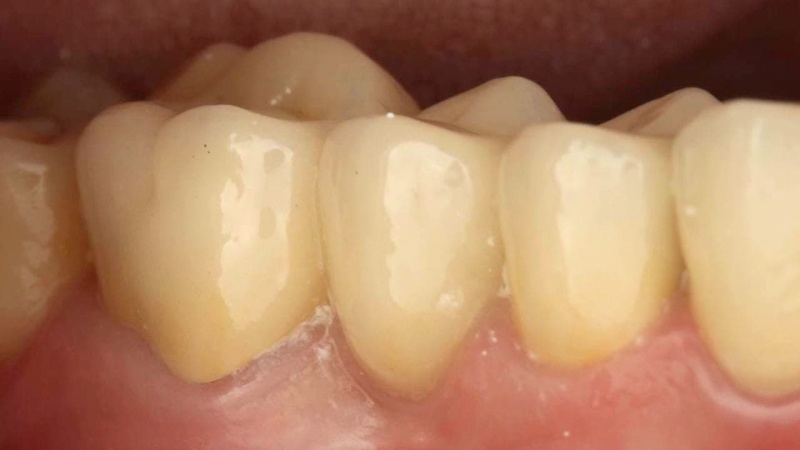 фото до протезирования жевательных зубов