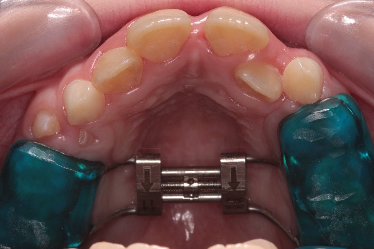 Фото зубов подростка в процессе носки ортодонтического аппарата