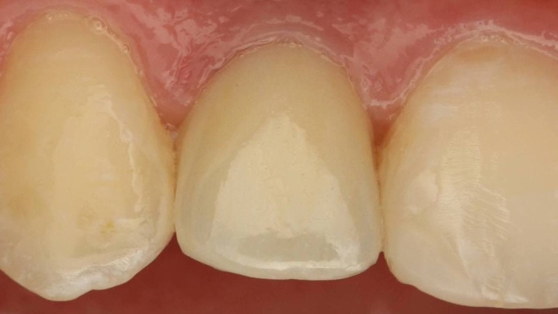 фото до имплантации переднего зуба