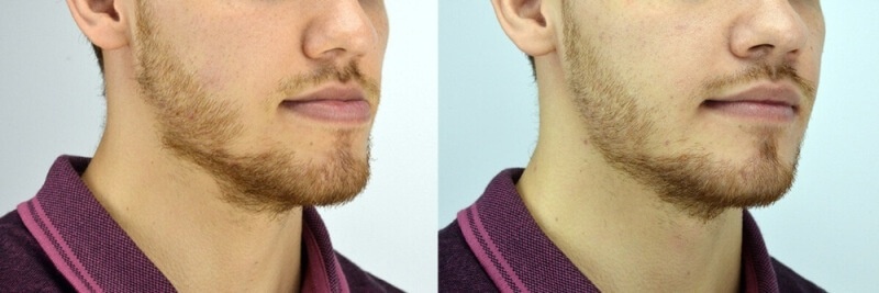 Фото положения челюсти до и после коррекции прикуса металлическими брекетами