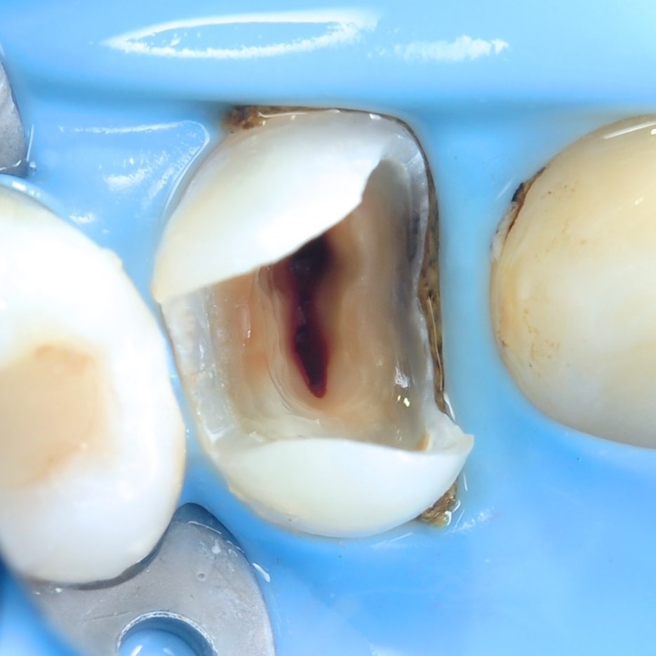 зуб пациента с обработанными каналами в процессе лечения под микроскопом
