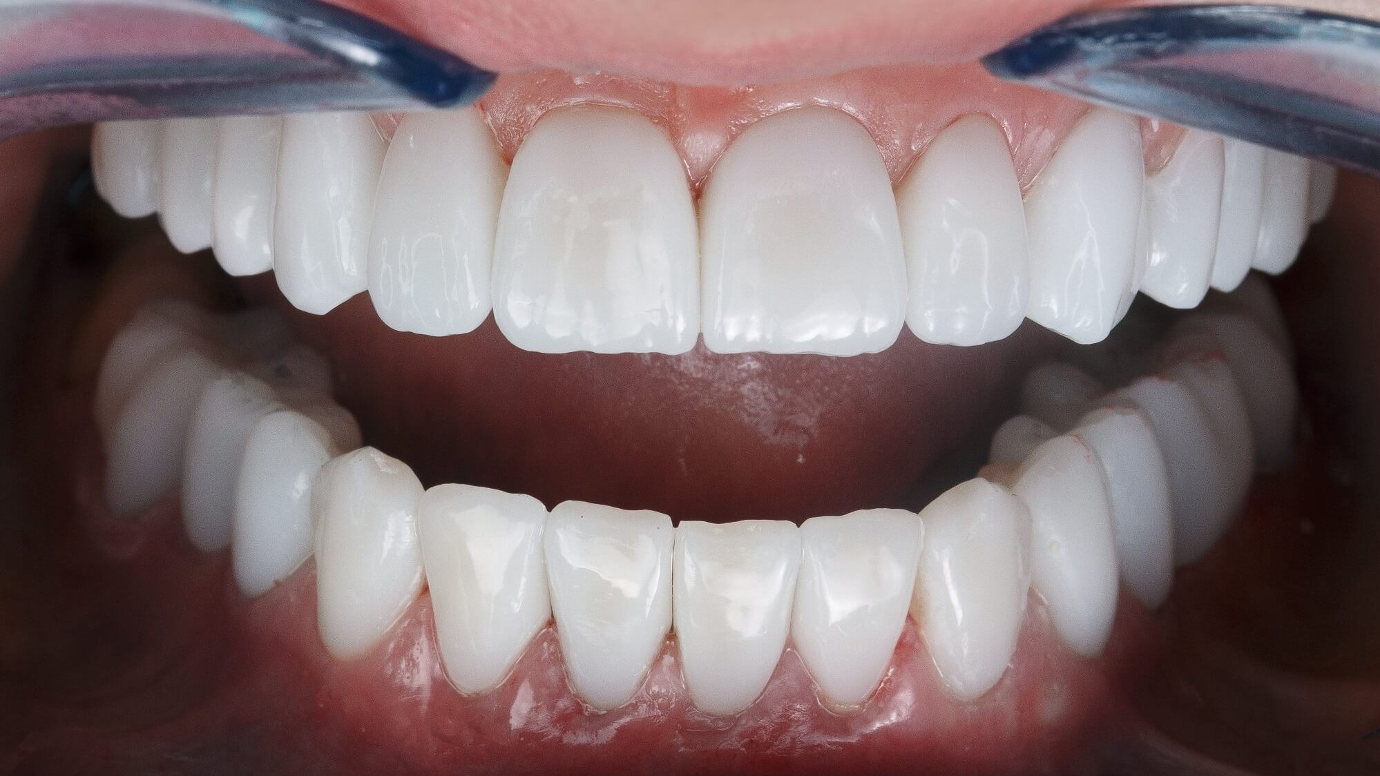 циркониевые коронки зафиксированные на зубах пациента