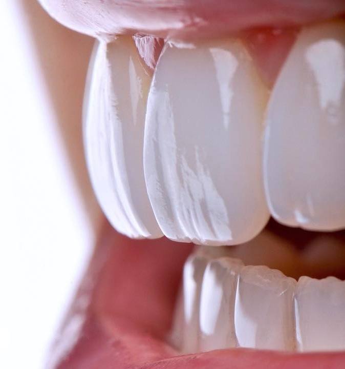 передние зубы с установленными керамическими винирами