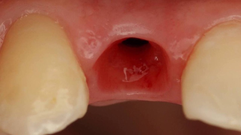 фото после имплантации переднего зуба