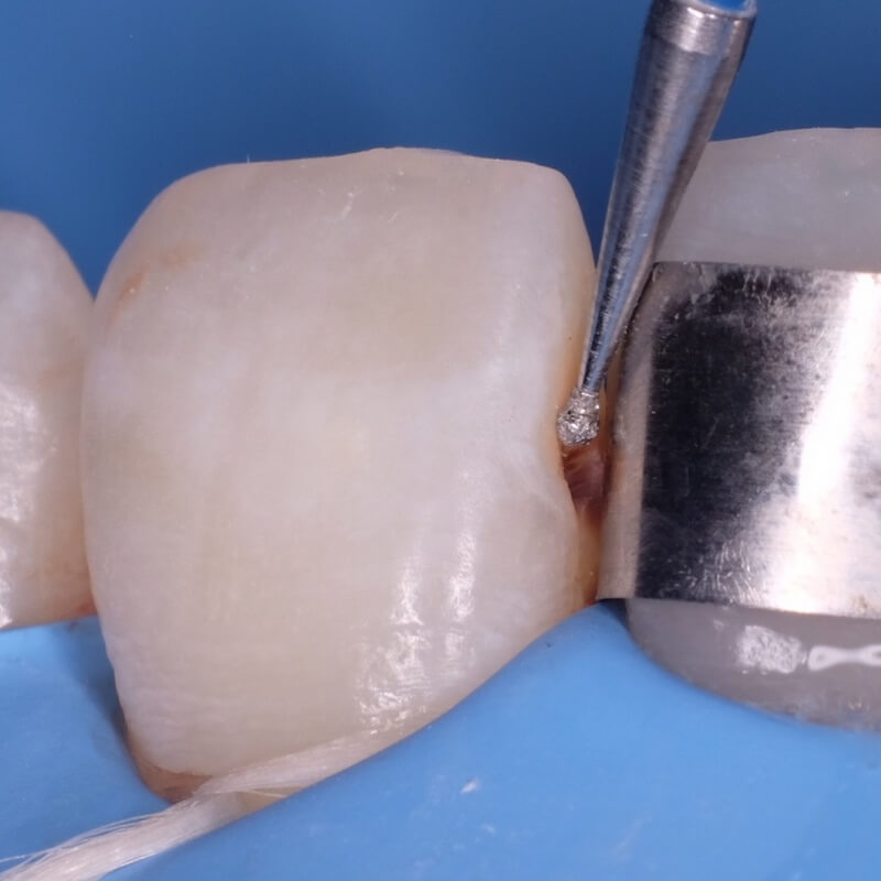 удаление кариеса стоматологическим бором