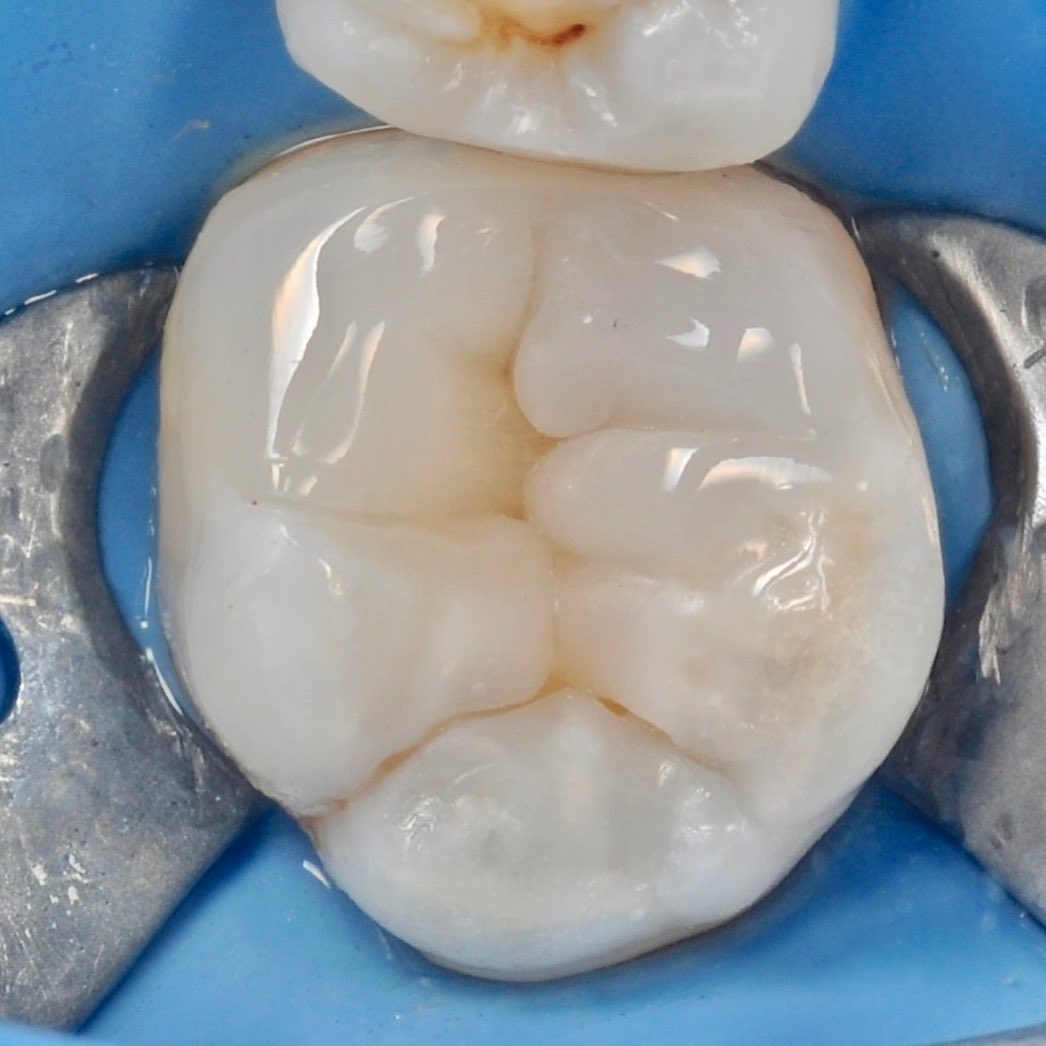 отполированный жевательный зуб после лечения под микроскопом