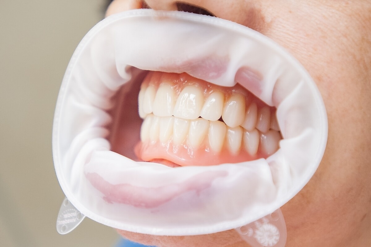 Съемные зубные протезы верхней и нижней челюсти во рту пациента