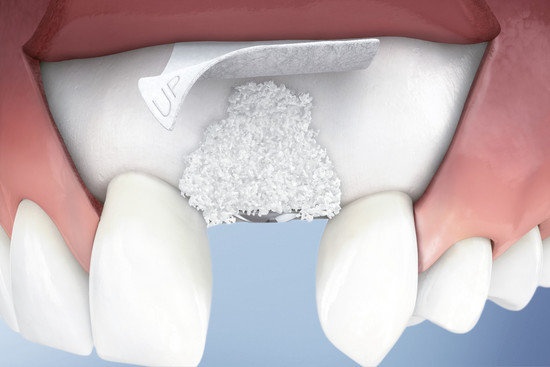 Костная пластика требуется при имплантации жевательных и передних зубов