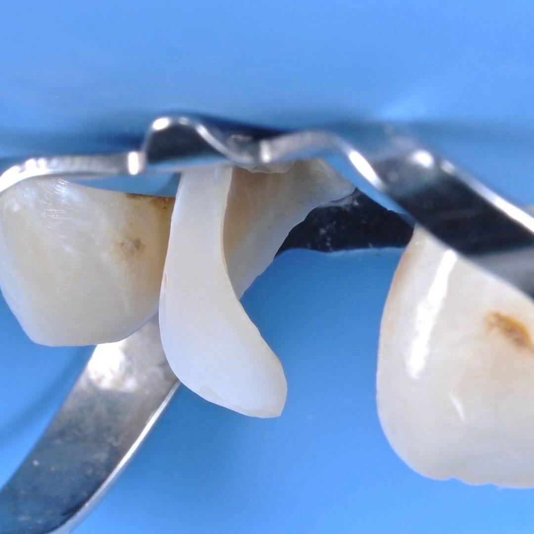 фото зуба в процессе лечения