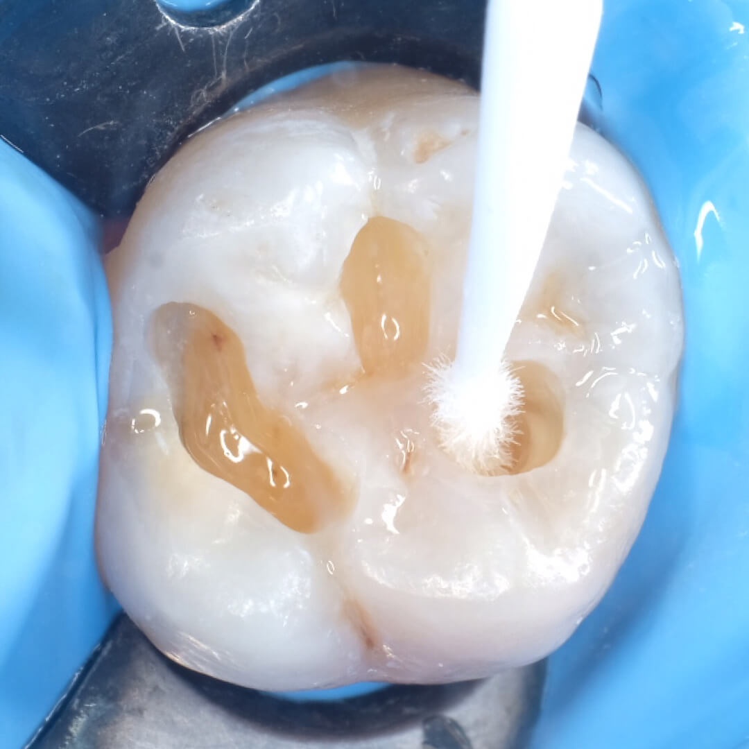 жевательный зуб готовится к пломбирове в процессе лечения кариеса
