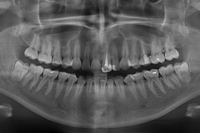 Ортопантомограмма сделанная в процессе консультации стоматолога в клинике Стомион
