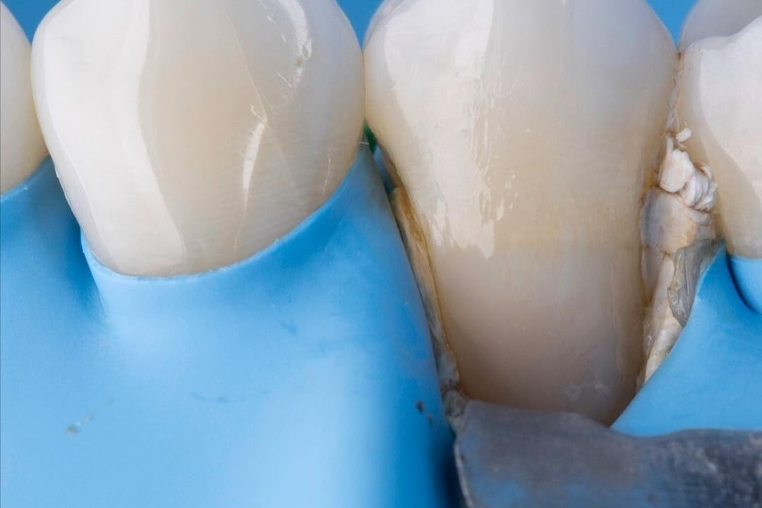 реставрация композитом пришеечной области переднего зуба