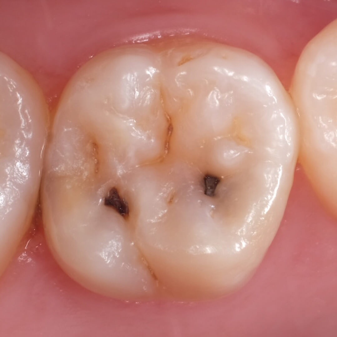 жевательный зуб до лечения кариеса