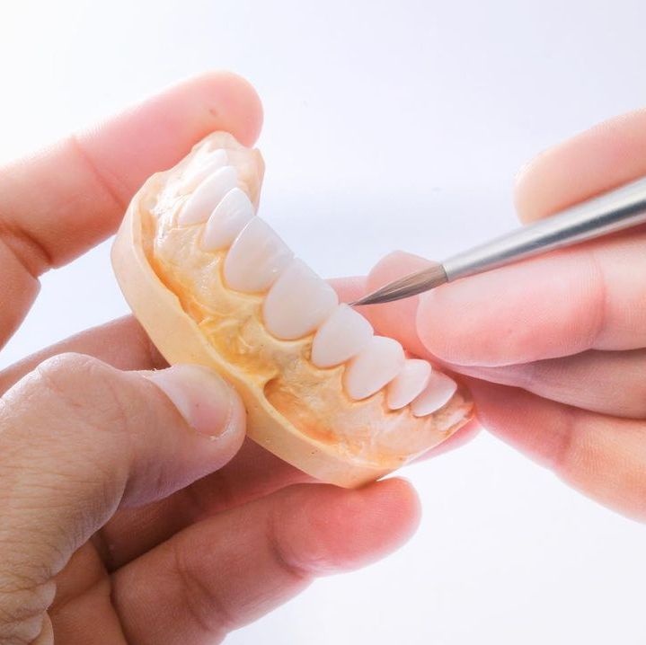 Керамический винир для фиксации на зуб выполненный по протоколу цифровой стоматологии